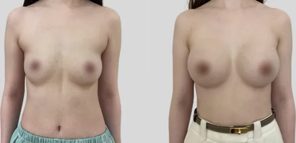 Before/After
