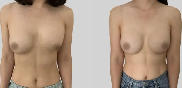 Before/After