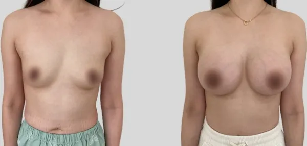 Before/After