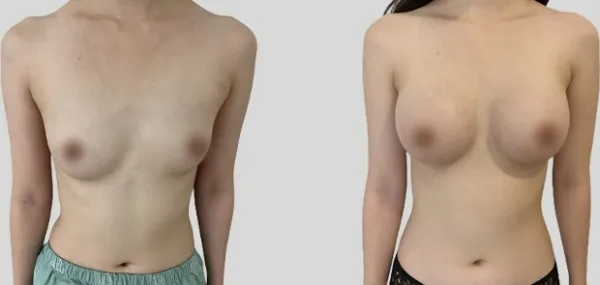 Before/After