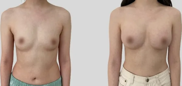 Before/After
