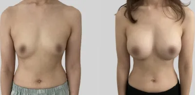 Before & After