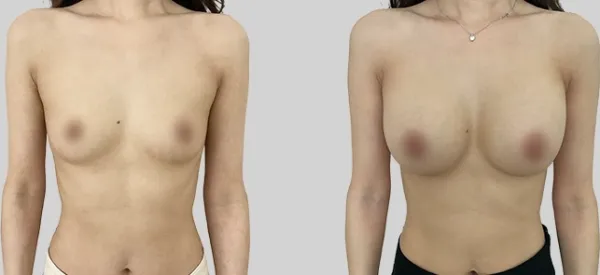 Before/After