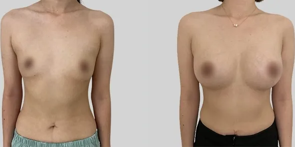 Before/After
