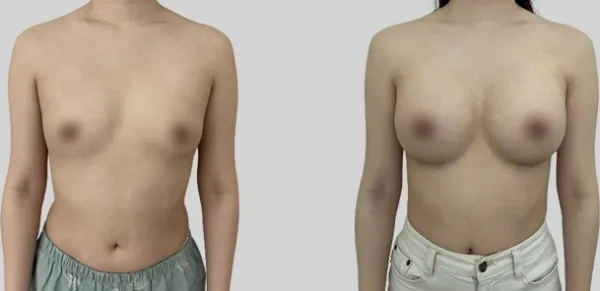 Before/After