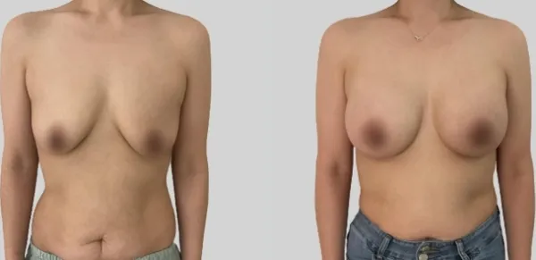 Before/After