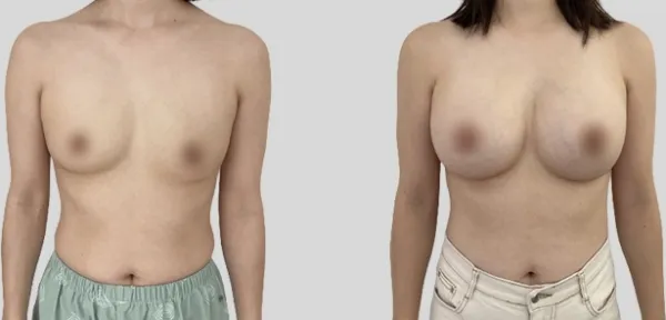 Before/After