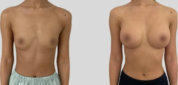 Before/After