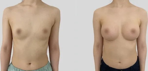 Before/After