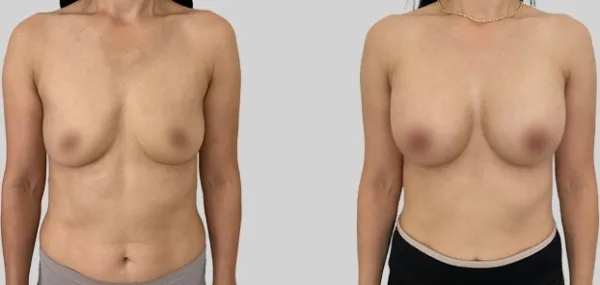 Before/After