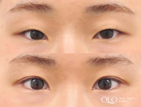 Before/After
