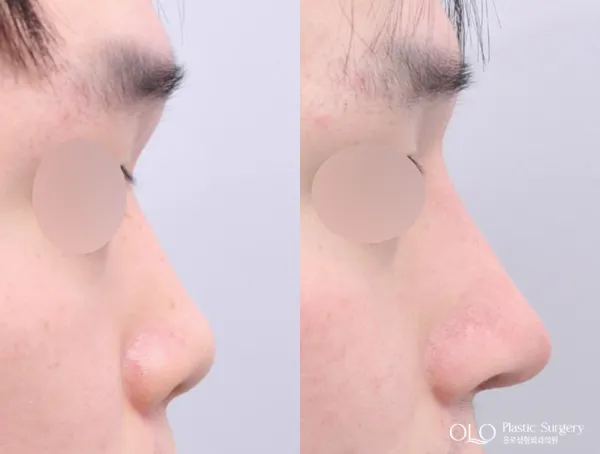 Before/After