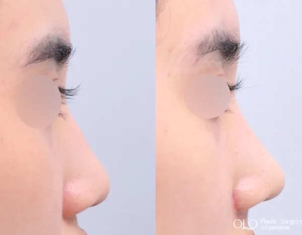 Before/After