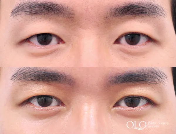 Before/After