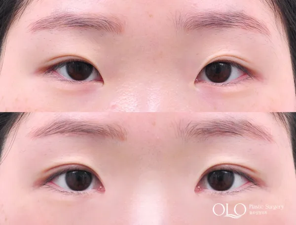Before/After
