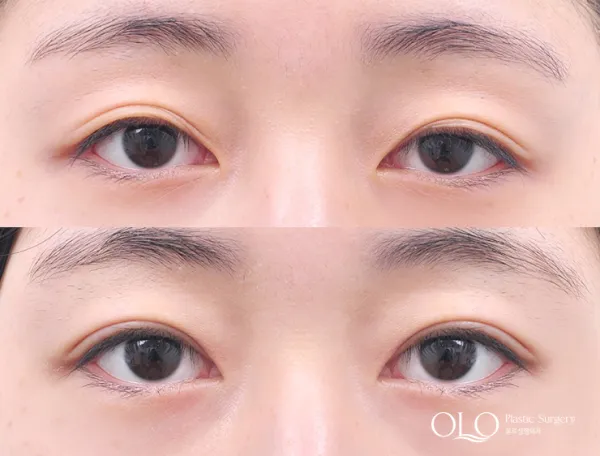 Before/After