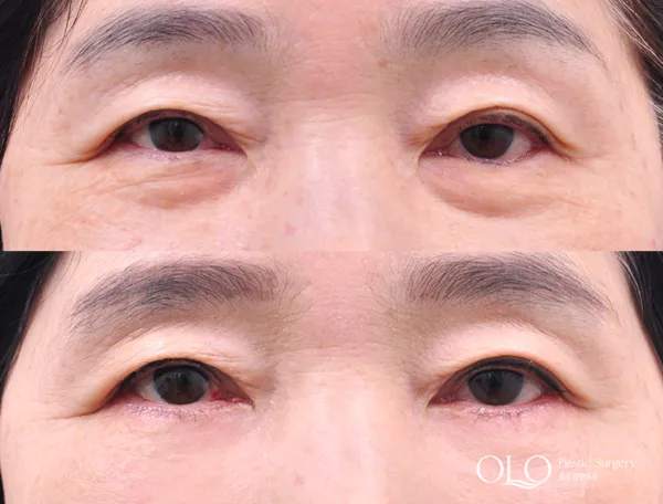 Before/After