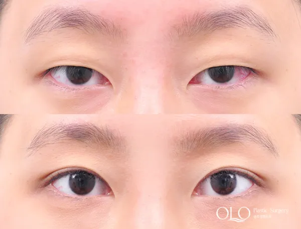 Before/After
