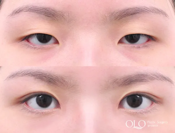 Before/After