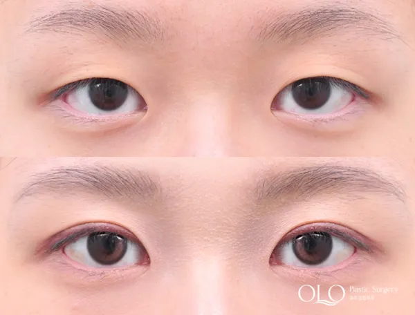 Before/After