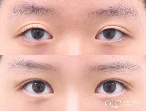 Before/After
