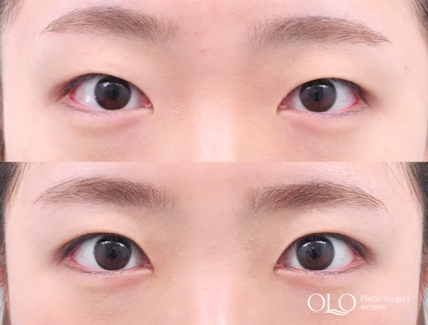 Before/After