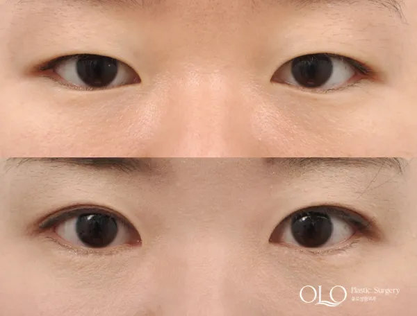 Before