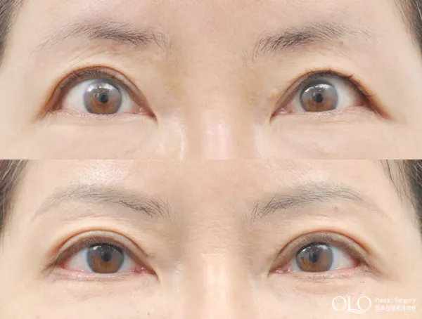 Before/After