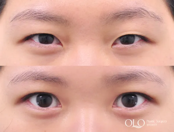Before/After