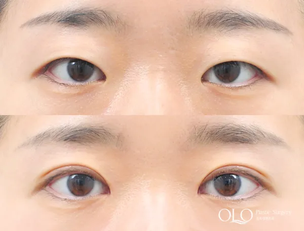 Before/After