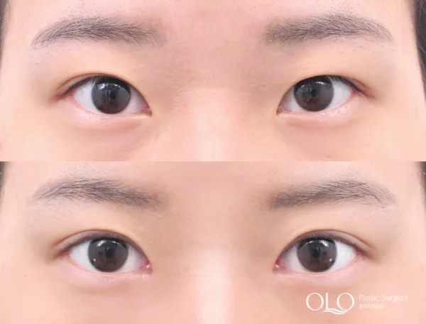 Before/After