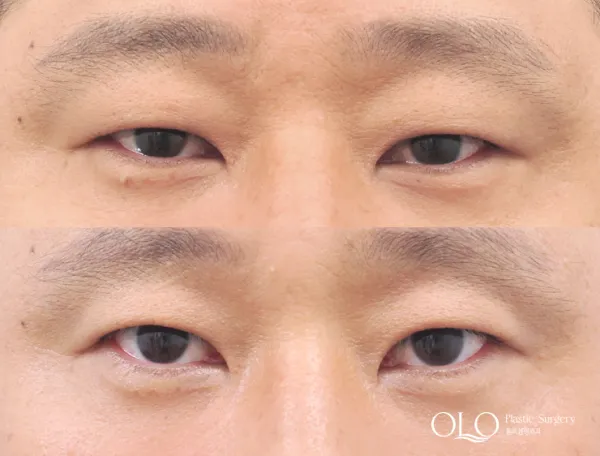 Before/After
