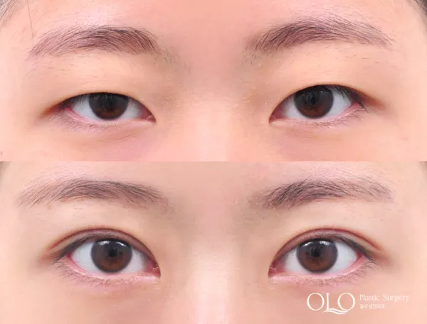 Before/After
