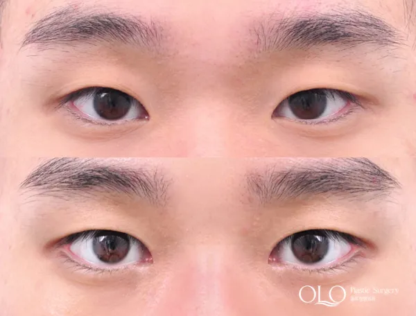 Before/After