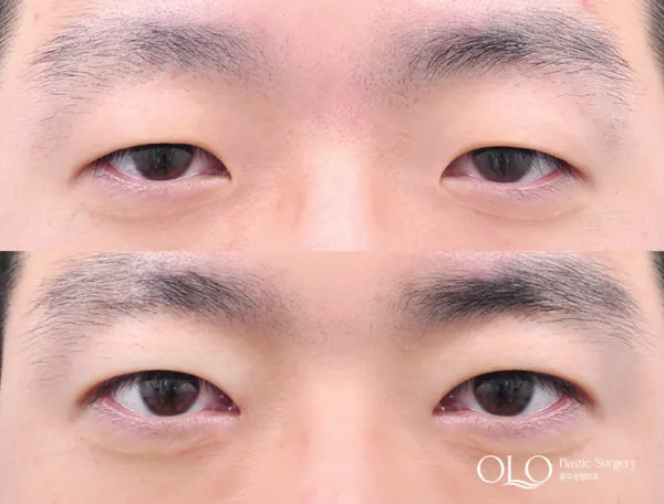 Before/After