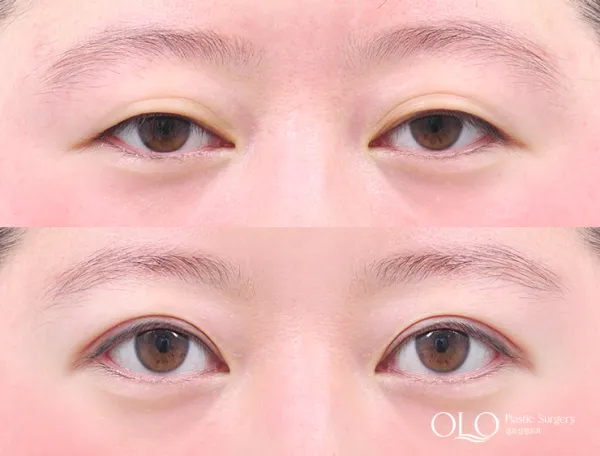 Before/After