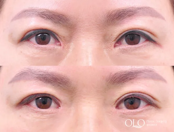 Before/After