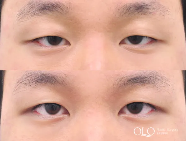 Before/After