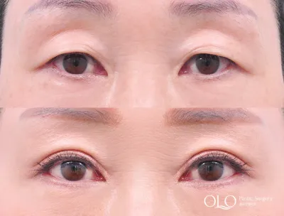 Before & After