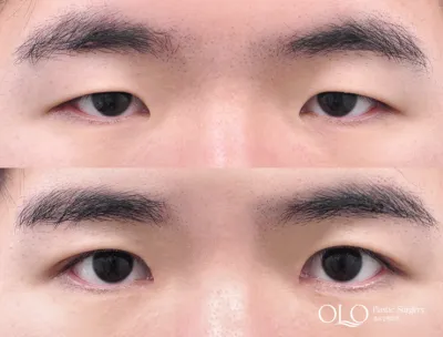 Before & After