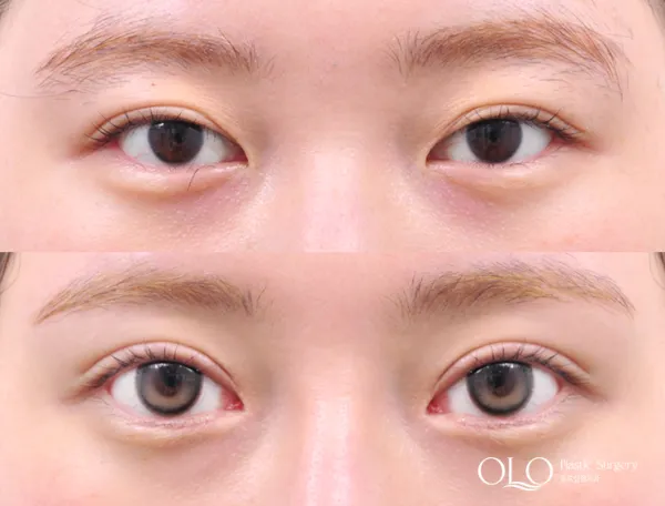 Before/After