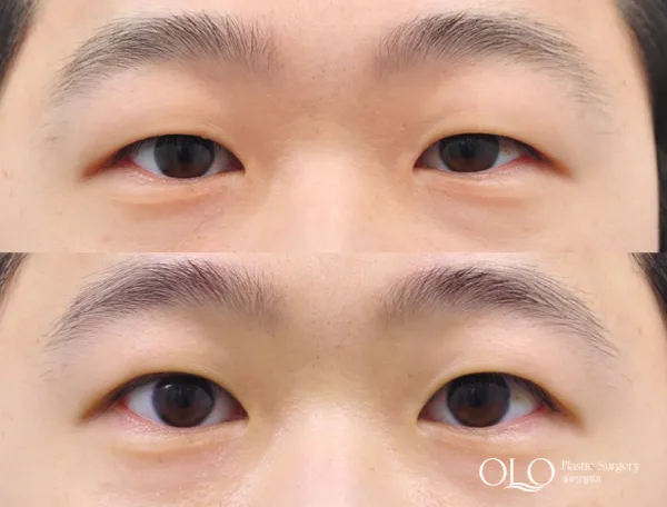 Before/After