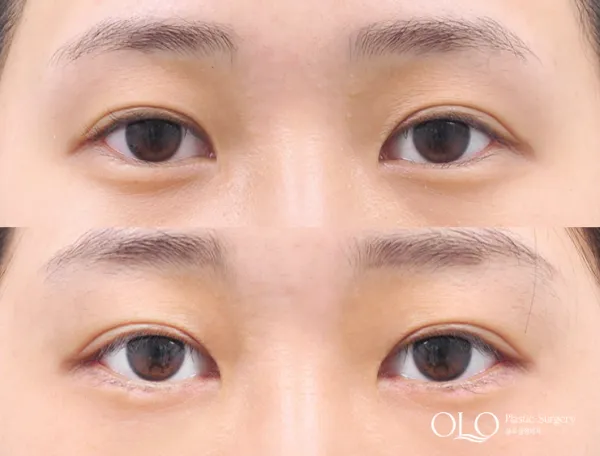 Before/After