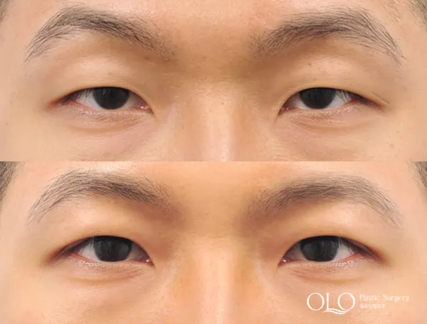 Before/After
