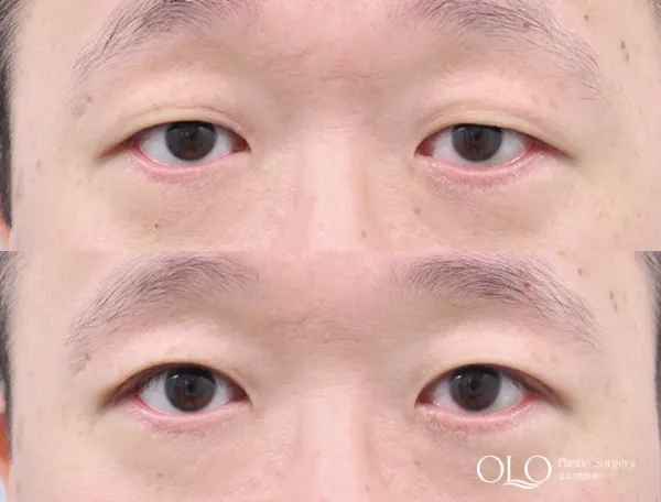 Before/After