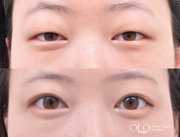 Before/After