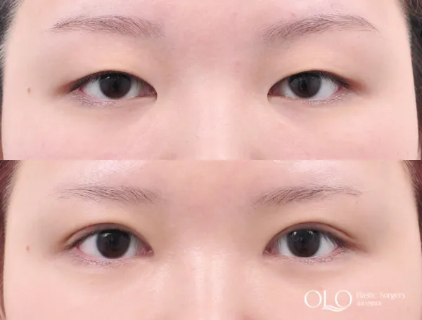Before/After