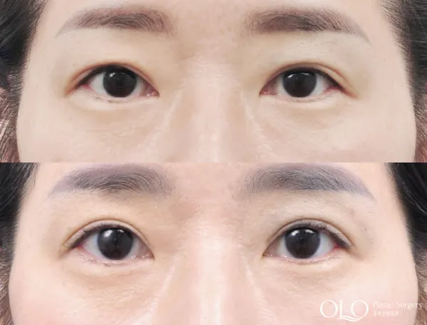 Before/After