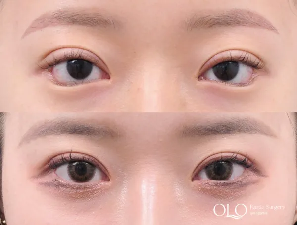Before/After