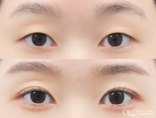 Before/After